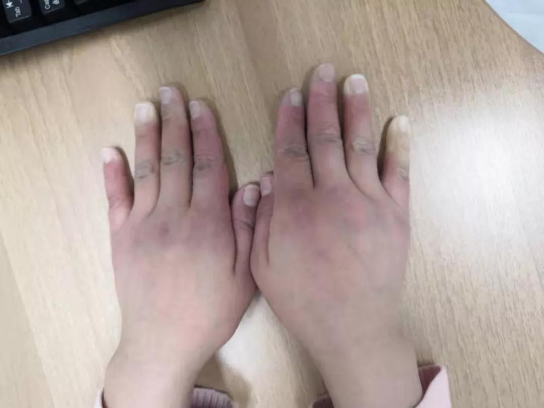 “手指、腳趾發(fā)白、發(fā)紫……”這些“小毛病”千萬別大意