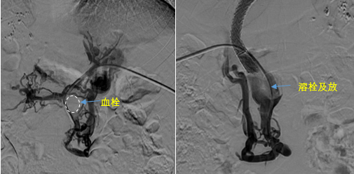 血栓攔路，如何破局——罕見巨大門靜脈血栓TIPS手術(shù)實錄