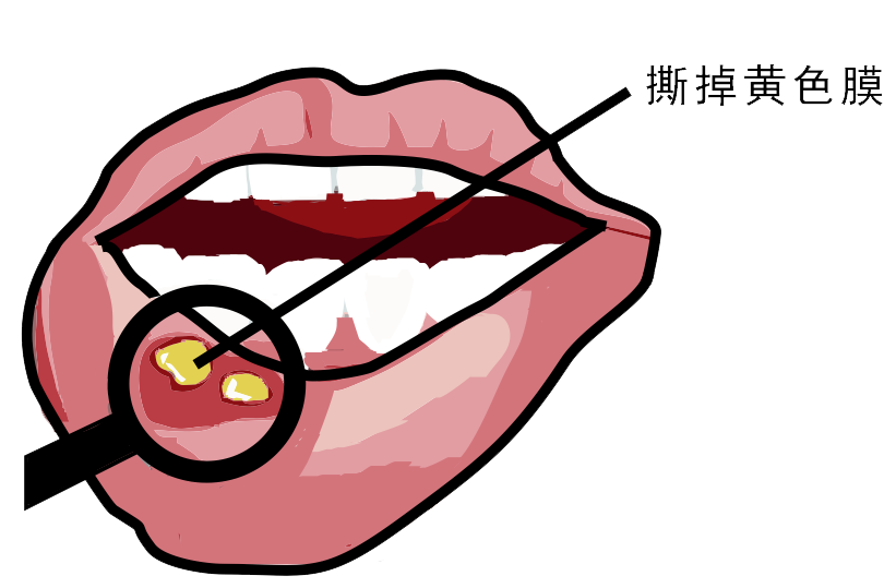 經(jīng)?？谇粷?，真的只是缺維生素嗎？