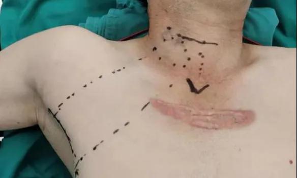 術(shù)后傷口可以“隱身”嗎？