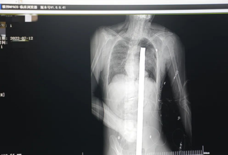 1.2米長的鋼筋貫穿男子胸腹！情況極度危險......