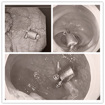 消化病醫(yī)院內(nèi)外科聯(lián)合開展3例“磁環(huán)預(yù)標記輔助腹腔鏡結(jié)、直腸癌根治術(shù)”