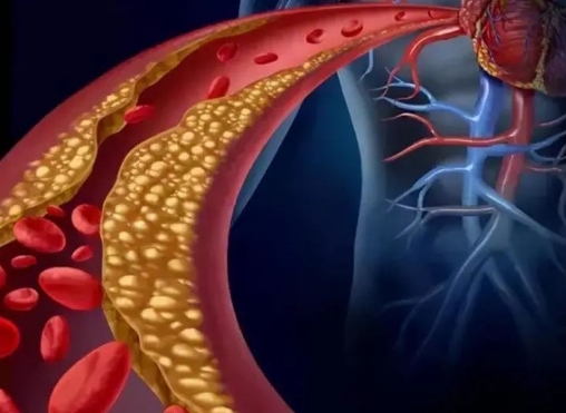 警惕！冠脈支架術(shù)后這些誤區(qū)千萬別踩，趕緊收藏！