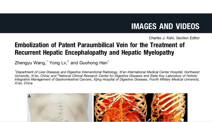 我院護(hù)理團(tuán)隊(duì)臨床成果登榜國(guó)際肝病權(quán)威期刊，影響因子11.6